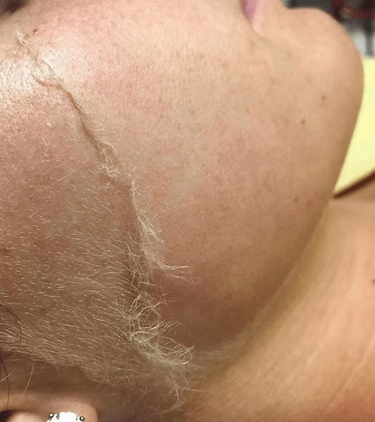Dermaplaning 2