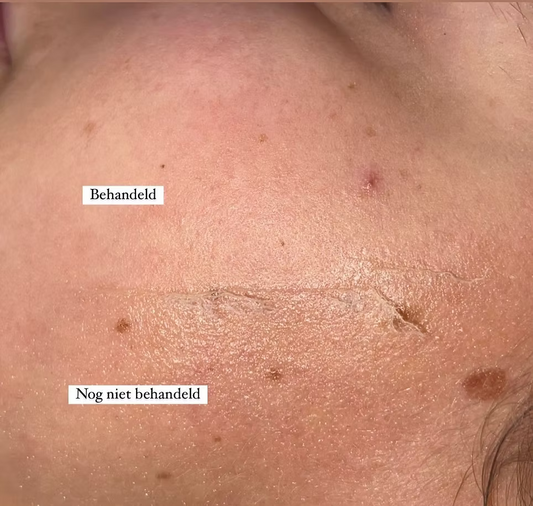 Dermaplaning 3